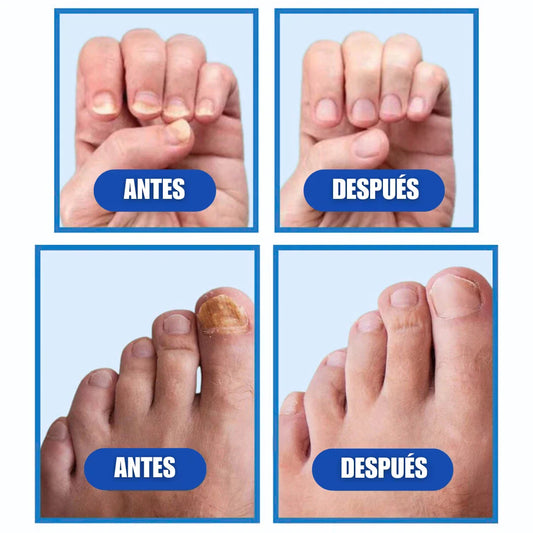 Tratamiento Láser Antihongos Laser